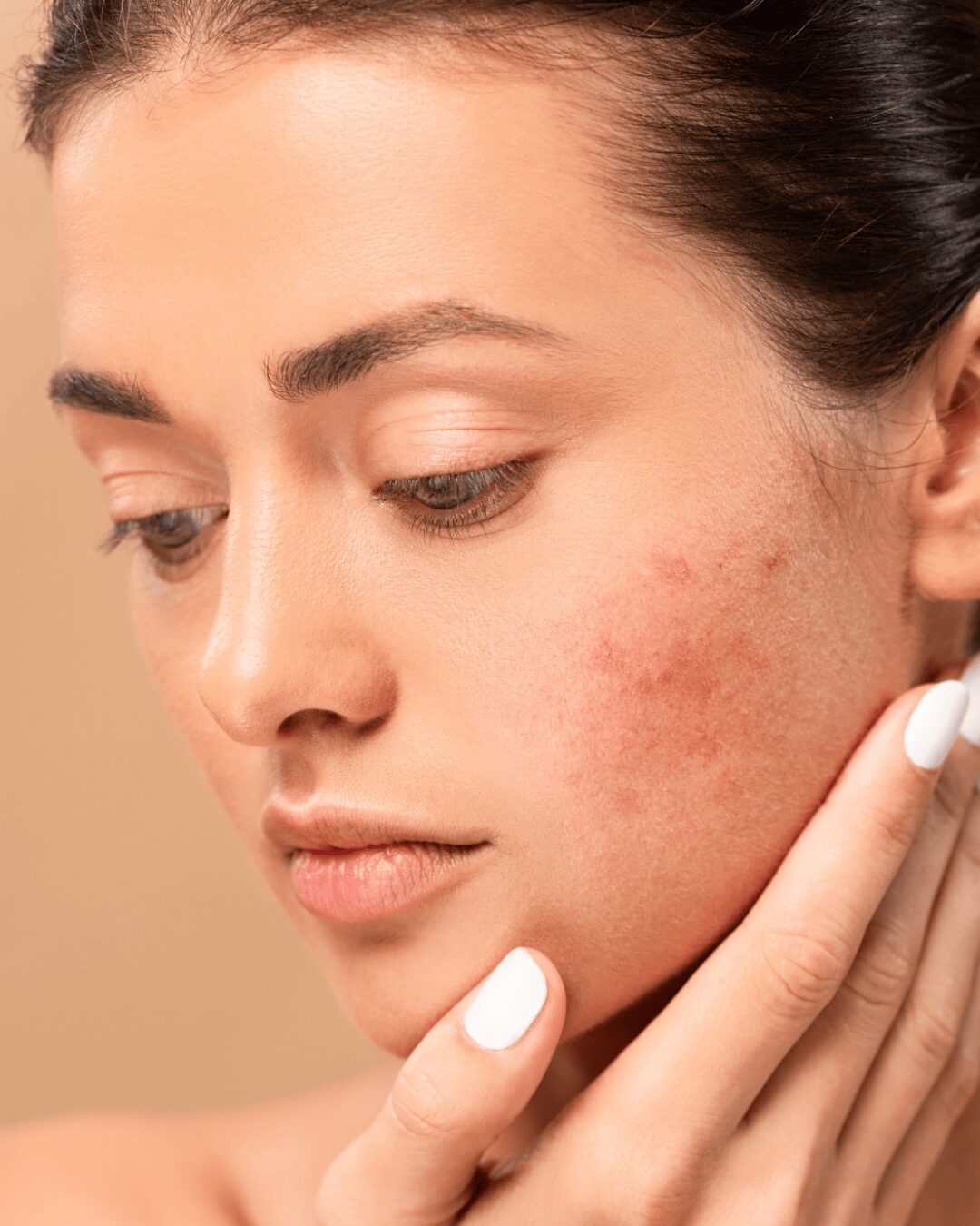 Chica con rosacea