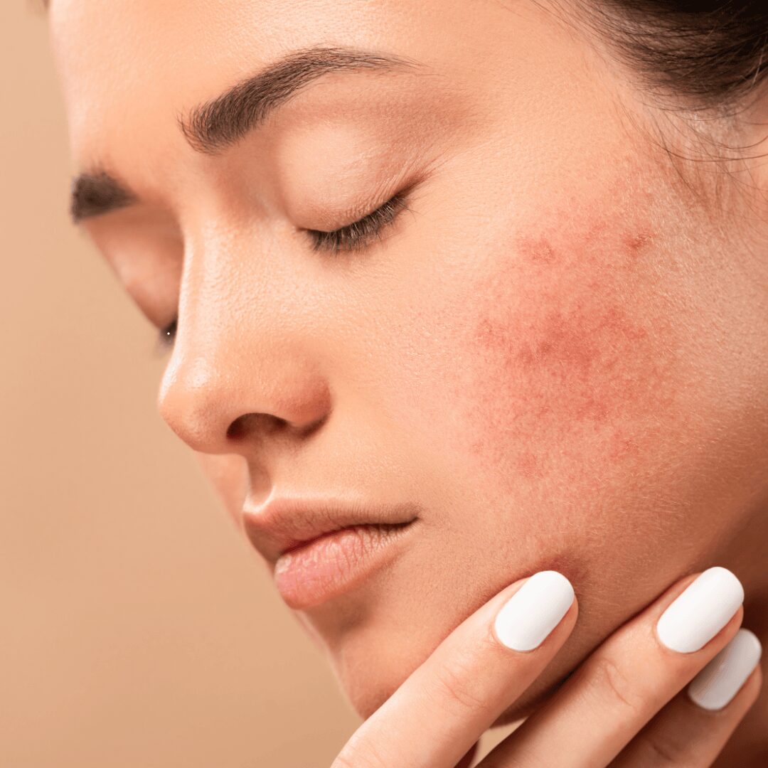 Chica con rosacea