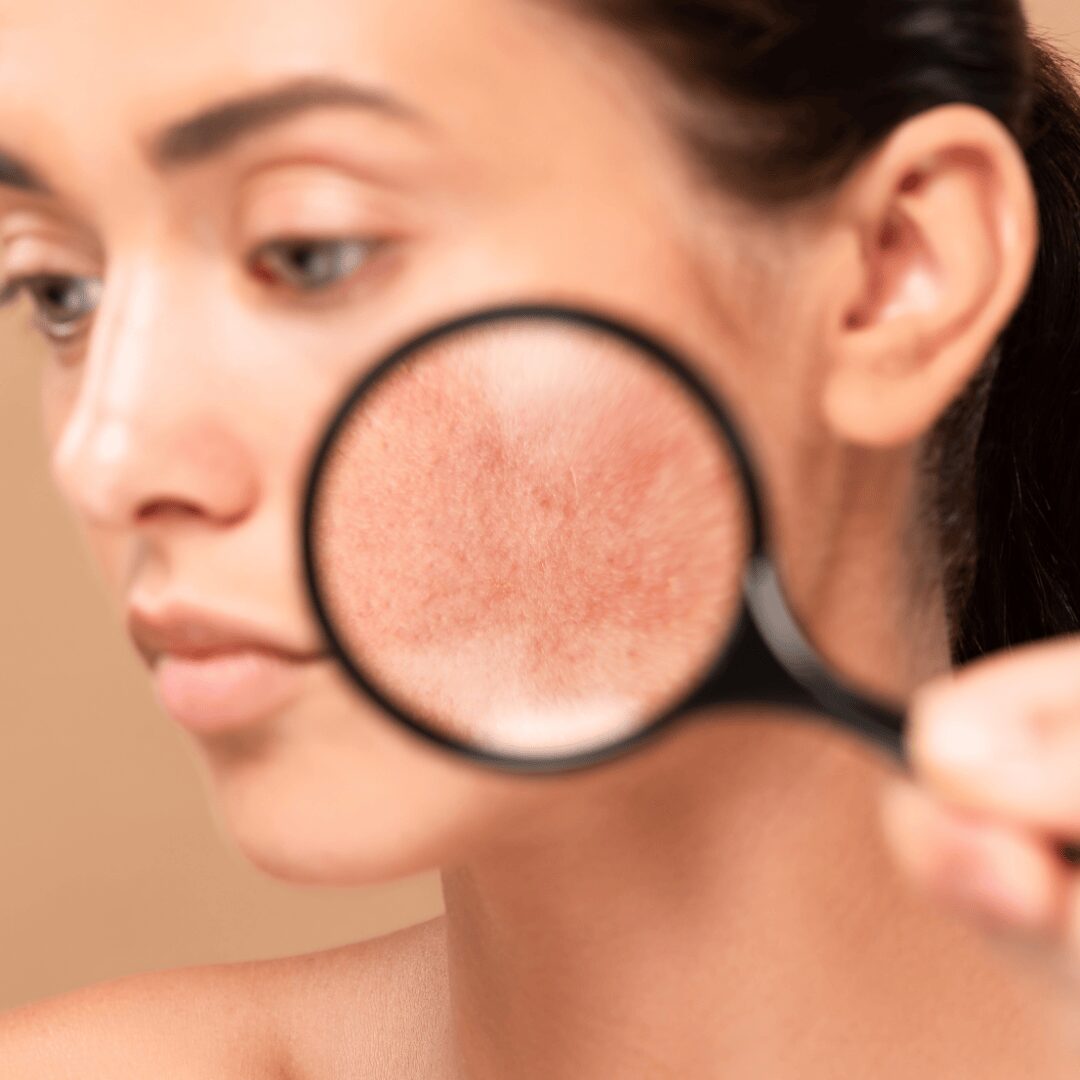 Chica con rosacea
